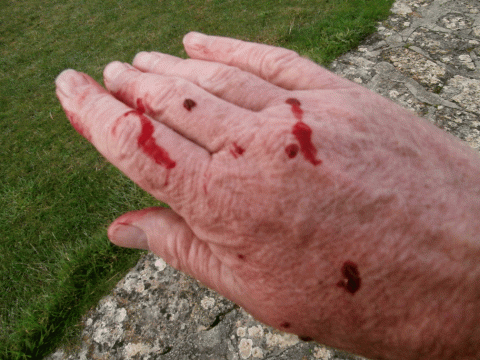 PA150612-bleeding-hand